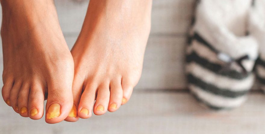 Consejos de salud: Tratamiento de los hongos en las uñas de los pies